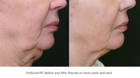 Profound Treatment Skin Tightening Treatment