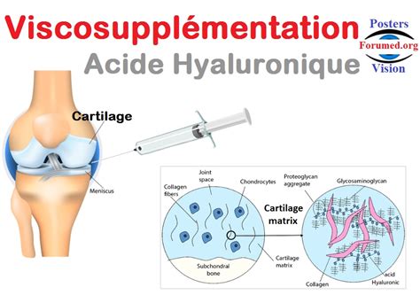 Viscosuppl Mentation Injection Intra Articulaire Dacide Hyaluronique