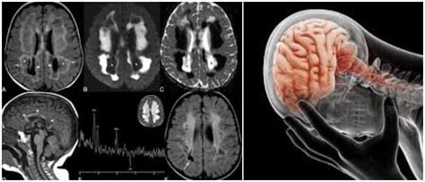 Leucoencefalopat A Qu Es Signos S Ntomas Causas Trastornos