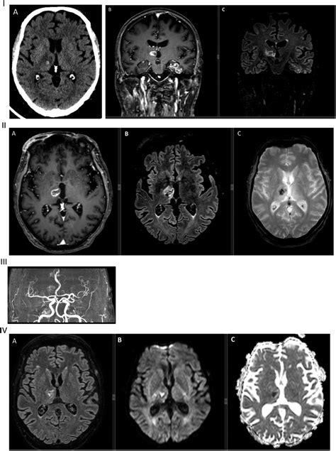 Covid Associated Acute Asymmetric Hemorrhagic Necrotizing