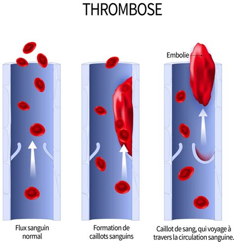 Embolie pulmonaire causes symptômes et traitements