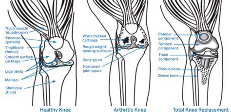 Types Of Knee Replacement Implants