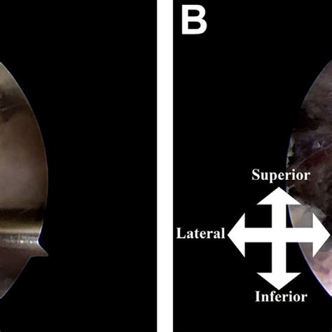 Arthroscopic Findings Of The Left Shoulder Prone Position A The