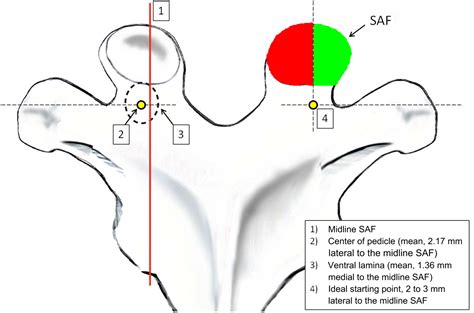 The Ventral Lamina And Superior Facet Rule A Morphometric Analysis For An Ideal Thoracic