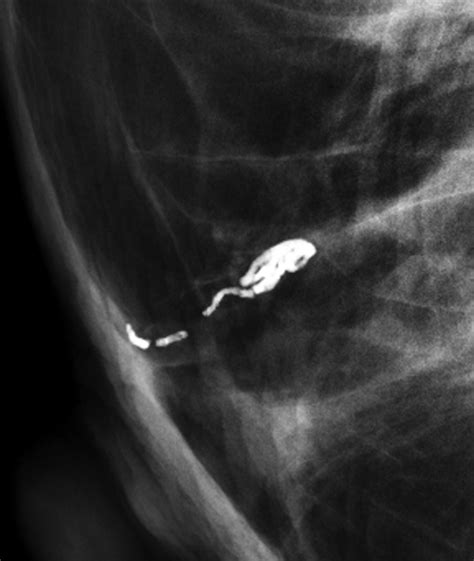 Linear Breast Calcifications AJR