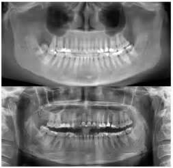 Comparison Of Mesiodistal Root Angulation Measured From Conventional