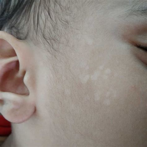 White Spots On Forehead