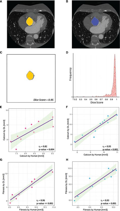 Sex Specific Cell Types And Molecular Pathways Indicate Fibro Calcific Aortic Valve Stenosis