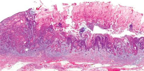 Keratoacanthoma Histology