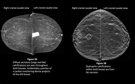 Benign Breast Calcifications StatPearls NCBI Bookshelf