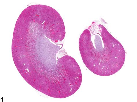 Renal Papillary Necrosis Histology