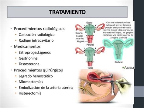 Cancer Cervico Uterino