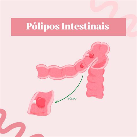 O Que São Polipos No Intestino - Tenho um Pólipo no Intestino. E agora? Dra. Aline Celeghini