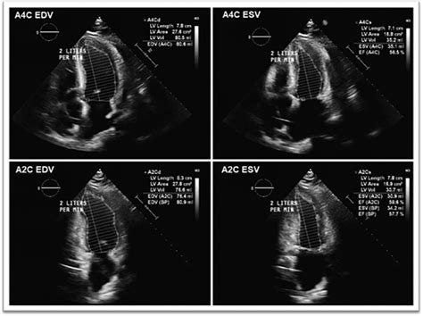 Transthoracic Echocardiogram On Day 5 After Successful ECPELLA