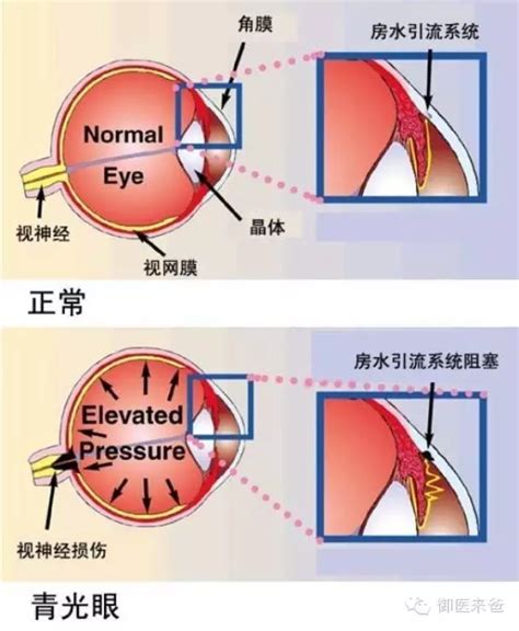 眼科科普之青光眼 姜鹏飞副主任医师 爱问医生