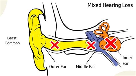 What Are The Different Types Of Hearing Loss And How Can We Treat Them