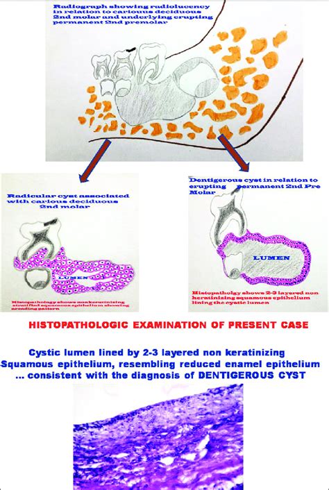 Dentigerous Cyst Histology