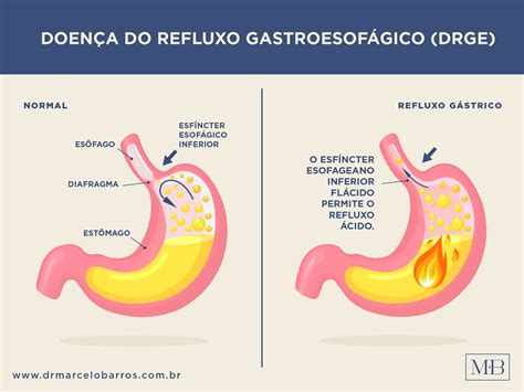 Dr Marcelo Barros Refluxo Gastroesof Gico