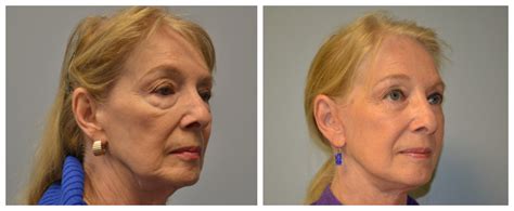 Atlanta Facelift Before and After Photos