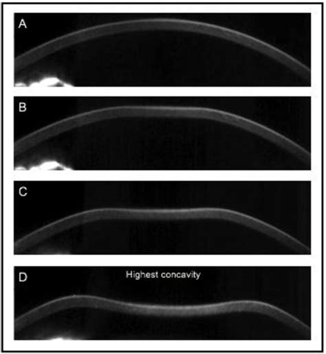 Review Of Corneal Biomechanical Properties Following LASIK And SMILE