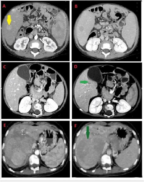 Triphasic Ct Of The Abdomen Of All Three Subjects A Triphasic Ct Of Download Scientific