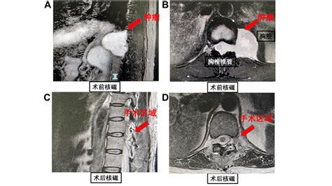 医学人文丨一台手术分两场，两科医生“无缝衔接”成功救治肿瘤患者脊髓进行官方