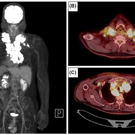 FDGPET CT Findings On Diagnosis Images Revealed Multiple Abnormal