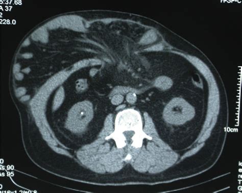 Figure 1 From Progressive Preoperative Pneumoperitoneum In Patients