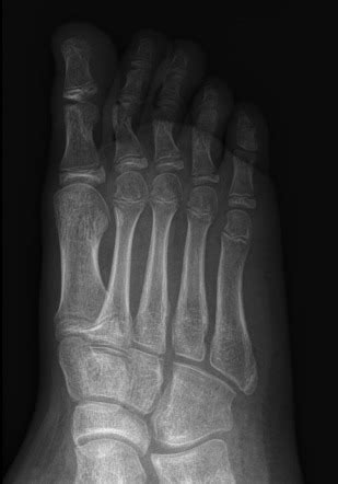 Apophysis Of The Proximal 5th Metatarsal Radiology Case Radiopaedia Org