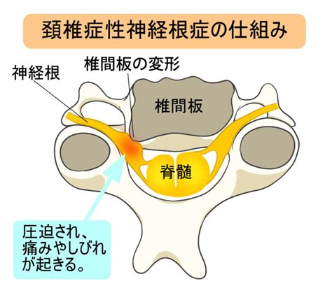 むちうちとは？定義や原因、具体的な症状、治療法、期間までを詳しく解説｜大分の交通事故弁護士