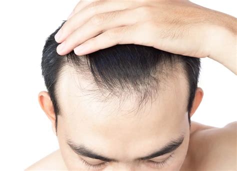 Hair Thinning At The Front Why And What To Do