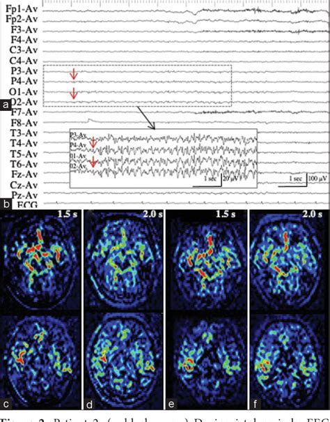 PDF Implications And Limitations Of Magnetic Resonance Perfusion