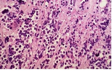 Histologic Section Is Demonstrating Small To Mediumsized Cells With Download Scientific Diagram