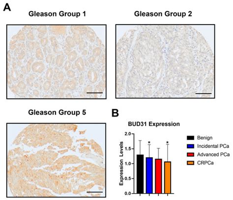 IJMS Free Full Text Downregulation Of BUD31 Promotes Prostate