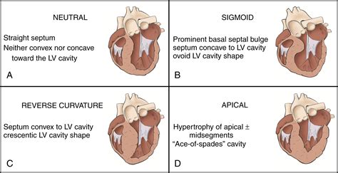 Pathophysiology And Variants Of Hypertrophic Cardiomyopathy Clinical Tree