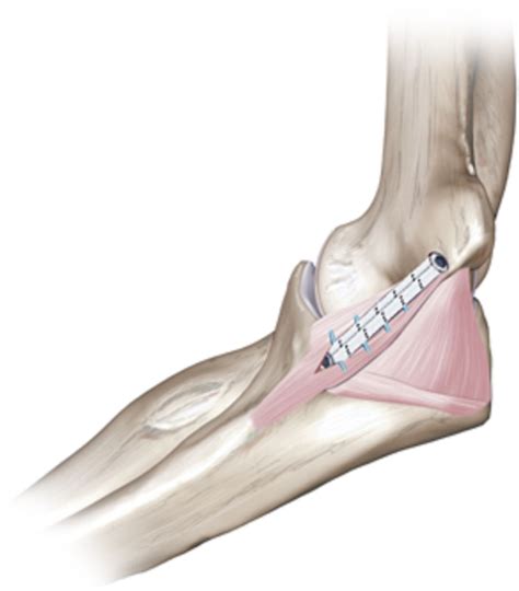 Ulnar Collateral Ligament Elbow Physical Therapy - edlasopa