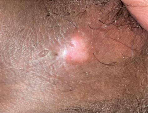 Need Help Identifying Bump On Penile Shaft And If Its Benign R