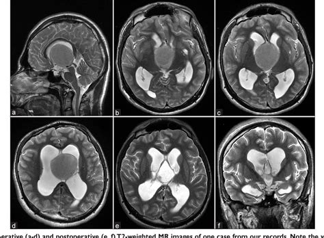 Figure 5 From Colloid Cysts Posterior And Anterior To The Foramen Of Monro Anatomical Features