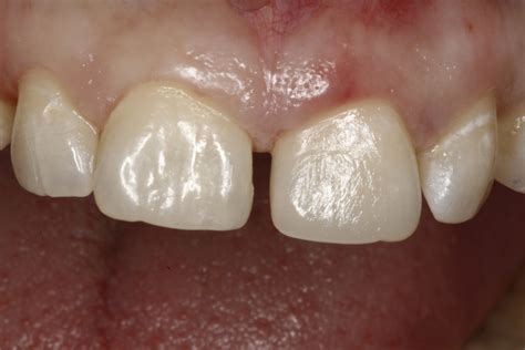 Composite Fillings Lisa L Buttaro Dds