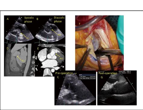 Ab Preoperative Transthoracic Echocardiography Tte In The Systolic