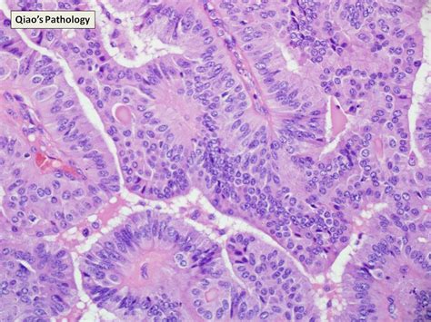 Qiaos Pathology Encapsulated Intracystic Or Encysted Papillary Carcinoma Of The Male Breast