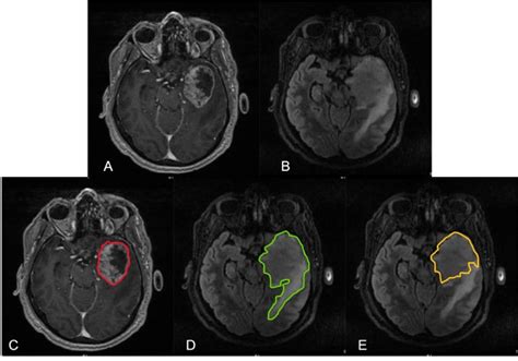 Preoperative Magnetic Resonance Imaging Highlighting Left Temporal Lobe Download Scientific