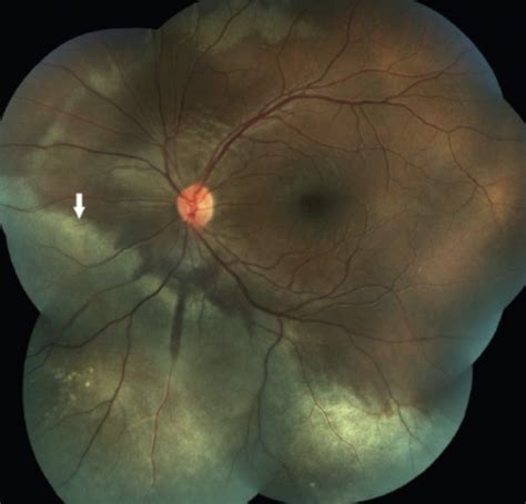 Ocular Disease 3 2 Trauma TED Preseptal Orbital Cellulitis Carotid