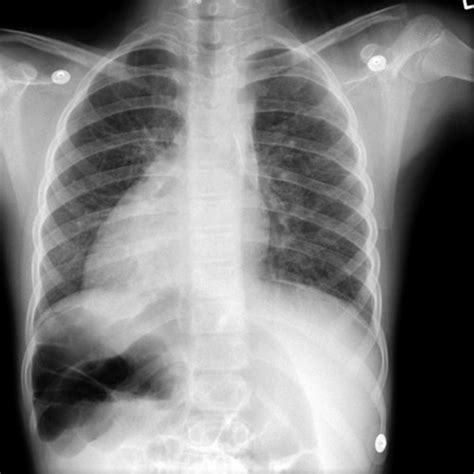 Pulmonology CXR Lecture Flashcards Quizlet