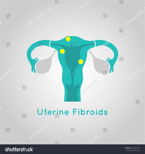 Uterine Fibroids Logo Vector Icon Design Stock Vector Royalty Free