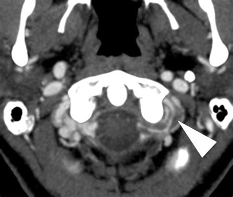 Vertebral Artery Dissection Mri