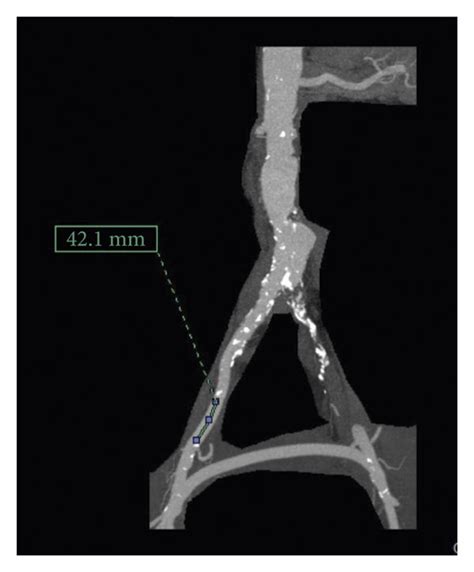 A And B Represent The Ct Angiography Reconstruction In A