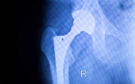 A Guide To Understanding Hip Replacement Surgery