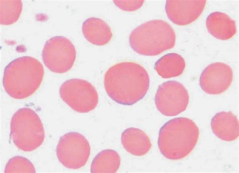 高色素性红细胞 实验诊断学图谱 医学
