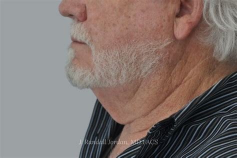 Neck Lift Case Faces Pllc In Ridgeland Ms